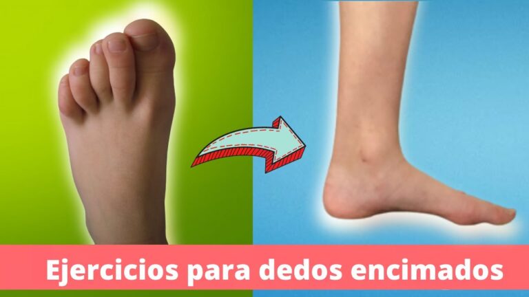 Corrección de dedos montados del pie: Guía práctica